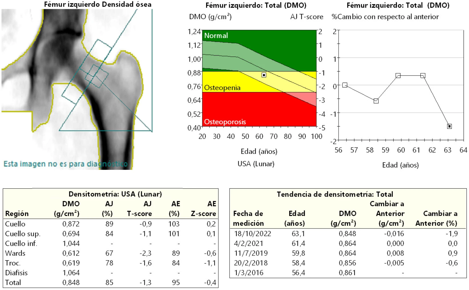 Estudio Fémur proximal